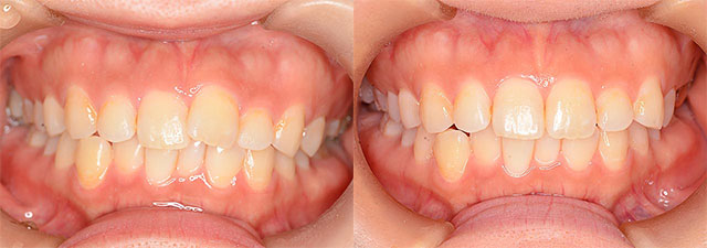八重歯の治療例