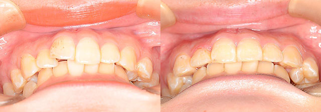 八重歯の症例