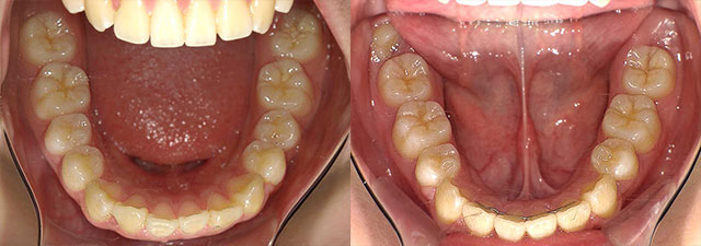 出っ歯の症例