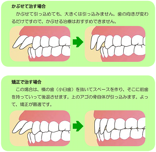 出っ歯の治療方法
