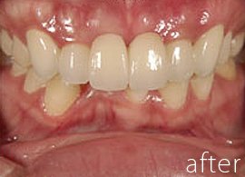 ガタガタの歯の症例写真：治療前