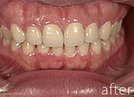 すきっ歯の症例写真：治療後