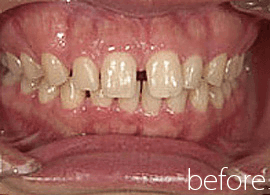 すきっ歯の症例写真：治療前