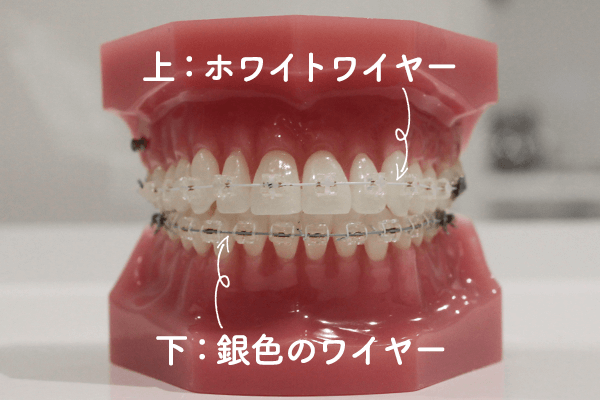 ワイヤーでの矯正治療 目立たない白い装置 クローバー歯科 ワイヤーでの矯正治療 目立たない白い装置 クローバー歯科