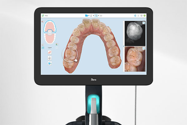 iTero