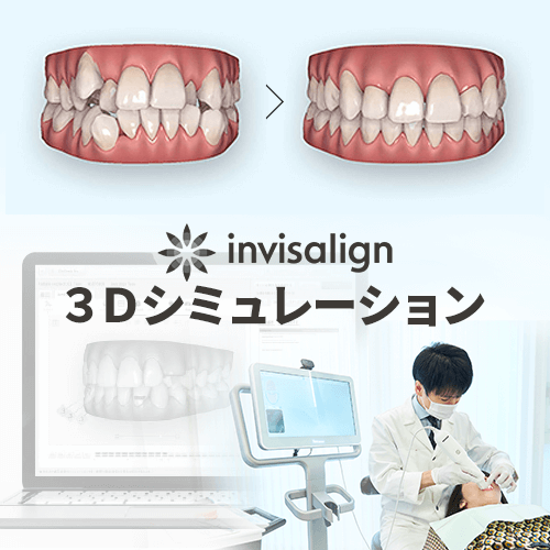 大阪でインビザライン マウスピース矯正 をしたい方は大阪矯正歯科グループへ
