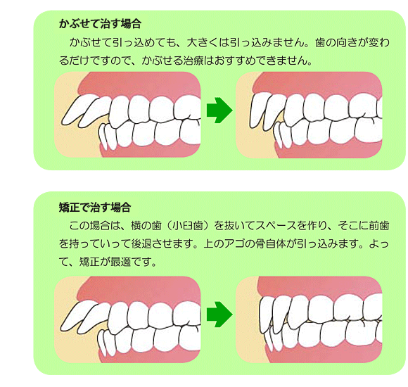 出っ歯 を 治す トレーニング