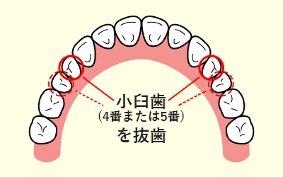 抜歯する歯の説明