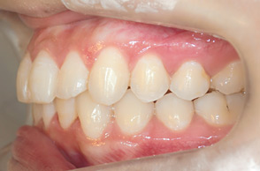 出っ歯（口ゴボ）の治療例2-2
