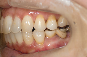 出っ歯（口ゴボ）の治療例3-2