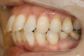 出っ歯（口ゴボ）の治療例3-1