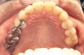 出っ歯（口ゴボ）の治療例3-3