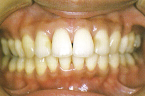 出っ歯（口ゴボ）の治療例3-4