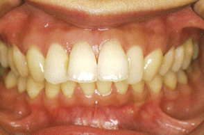出っ歯（口ゴボ）の治療例3-3