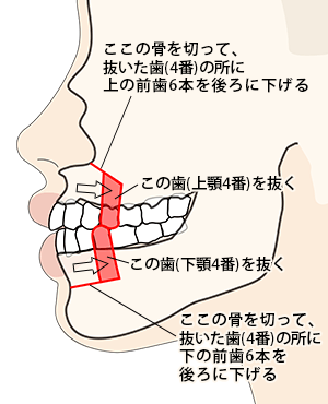 上あごセットバック(出っ歯)