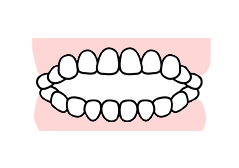 開口(前歯が噛まない)