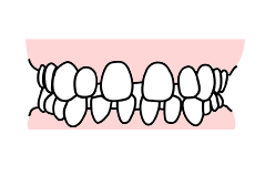 でこぼこ歯、八重歯