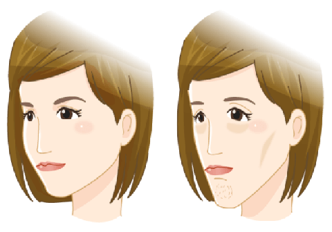 口呼吸によるお顔の変化