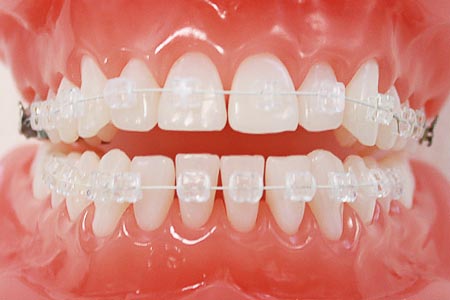 ホワイトワイヤー矯正