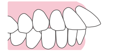 前歯だけが出っ歯