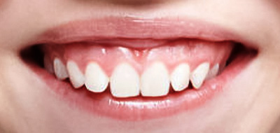 ガミースマイル